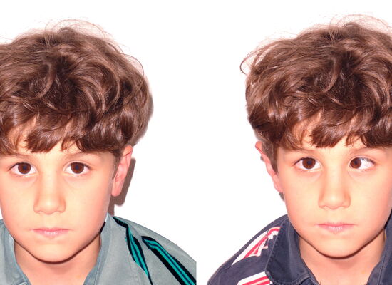 Zwei kleine Jungen. Der rechte schielt mit dem linken Auge stark nach innen.